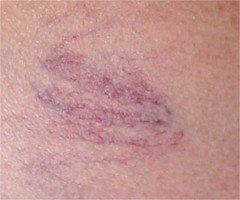 t�langiectasies