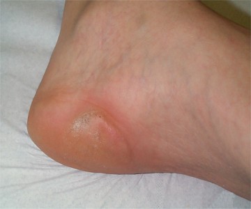 Cicatrice corn�e apr�s traitement par laser CO2