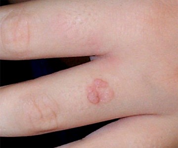 Verrue vulgaire récidivée sur son pourtour (HPV 2 ou 4)