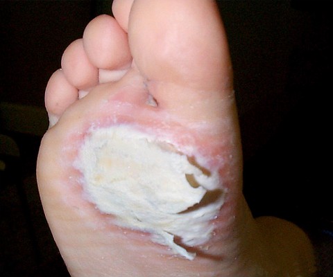 Verrues apr�s 3 semaines de traitement par vaseline salicyl�e