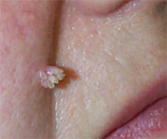 Papillome verruqueux � HPV 2