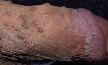 Verrues du p�nis (condylomes) � HPV g�nital (HPV 6,11,16...)