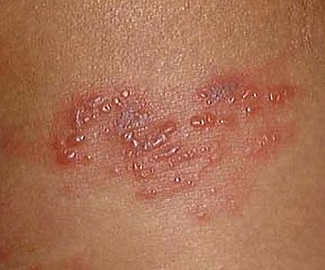 Zona : plaque de v�sicules vue de pr�s