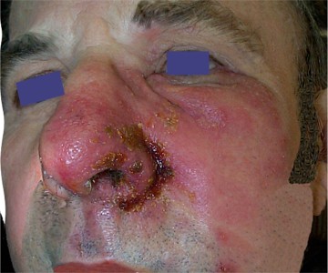 Zona � risque de complication oculaire